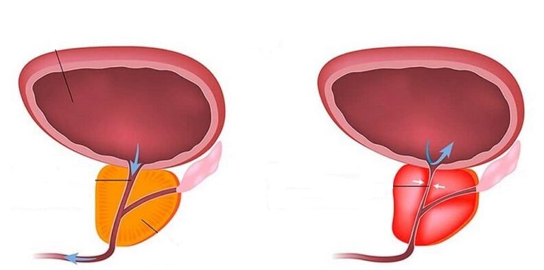Veselīga un iekaisusi prostatu ar prostatītu