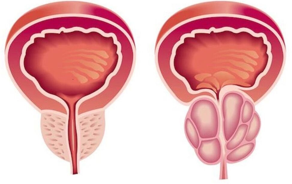 vesela un iekaisusi prostata ar prostatītu